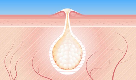Pimple, juvenile acne. Section of a pimple, side view. Human anatomy. Adolescent youth development, damaged skinの写真素材