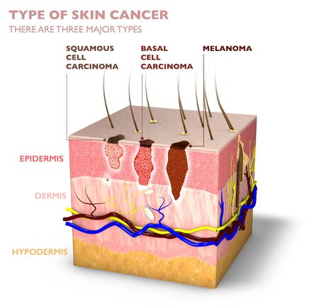 Skin tumors, moles and spots, 3d section of the skin layer. Three types of skin cancer, squamous cell carcinoma, basal cell carcinoma, melanoma. 3d renderの写真素材