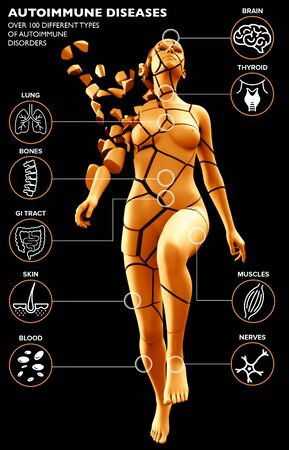 An autoimmune disease is a condition in which your immune system mistakenly attacks your body and causes your immune system to turn on itself. This leaves your body susceptible to diseases, bacteria, and illness. Broken naked woman disintegrating. 3d renderの写真素材