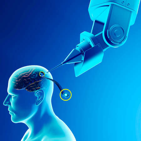 Link, neuralink, new artificial intelligence technology that allows you to connect to the human brain. Neuralink sensors ready to be installed in the skull of a human. 3d renderの写真素材
