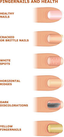 Problems with nails. Fingertips. Nail health. Types of problems affecting the extremities of the human bodyのイラスト素材