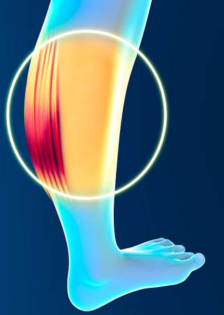 Muscle strain, inflammation of the muscles. Calf. Cramps. Tendons. Contracture. Human body and anatomy, fitness, physical exercises to keep in training. 3d renderの写真素材