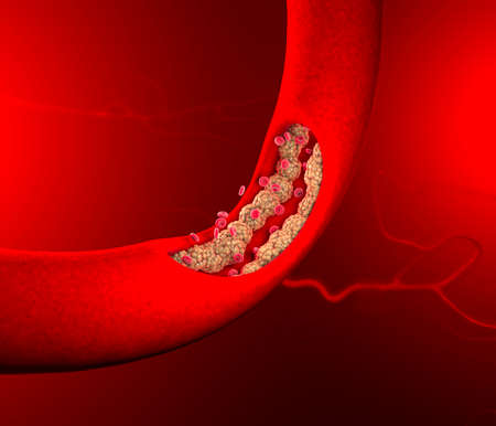 Cholesterol formation, fat, artery, vein, heart. Red blood cells, blood flow. Narrowing of a vein for fat formation. Surgery operation, 3d renderの写真素材