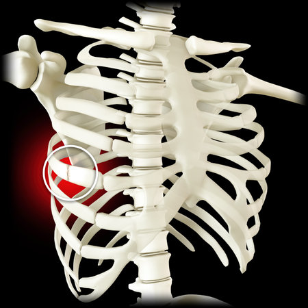 Anatomy and the human body. Costochondral separation, separated rib. Broken, fractured ribs. Bones in the rib cage breaks or cracks. The chest hurt more with deep breath. Perforated lung. 3d renderの写真素材