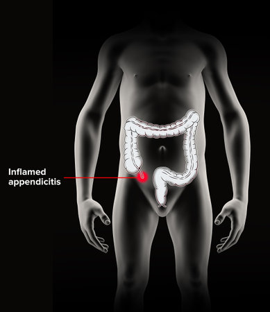 The appendix is a finger-like, blind-ended tube connected to the cecum. The cecum is a pouch-like structure of the colon. 3d render. Appendicitis is inflammation of the appendix.の写真素材