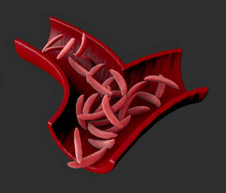 Sickle cell disease is a group of blood disorders. Sickle cell anemia. It results in an abnormality in the oxygen-carrying protein haemoglobin found in red blood cells. 3d renderの写真素材