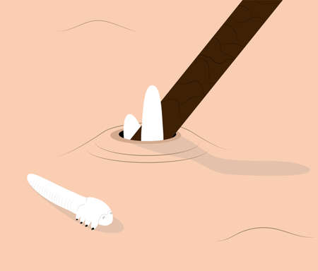 Demodex mites blocking hair follicles and laying on skin. Illustration of light skin infected with demodicosis.のイラスト素材