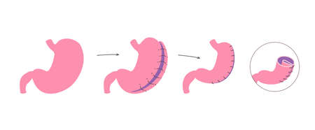 Gastric plication flat infographics. The explanation picture of stomach reduce method via laparoscopic operationのイラスト素材