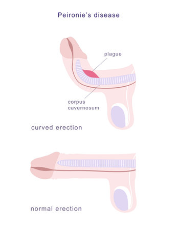 Medical chart of Peironies disease. Side view of human penis in normal erection and curved, demonstrating fibrous plague on its erectile tissue.のイラスト素材