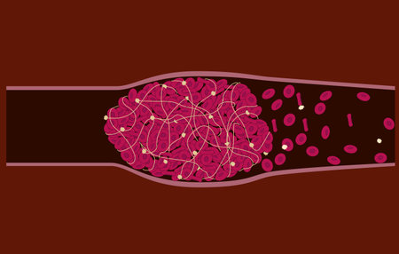 A blood clot stops the flow of the blood in a vein and causes its swelling. Thrombus in a blood vessel.のイラスト素材