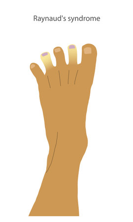 A foot with Raynauds syndrome symptoms on tips of the toes. Peripheral cyanosis shown as white and discoloured toes.のイラスト素材