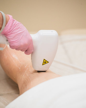 The procedure of laser hair removal on the skin of the legs of a woman - smooth silky skin by...