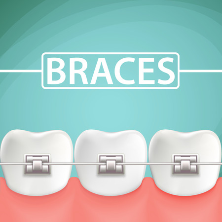 Human teeth with metal braces. Stock cartoon illustration.のイラスト素材