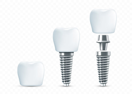 Dental implant scheme. Template isolated on transparent background. vector mockupのイラスト素材