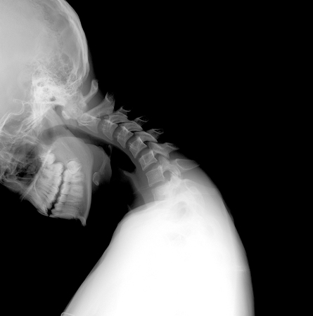 X-ray of neck and cervical spine function test lateral (LAT) - Instability