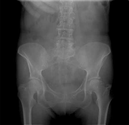 X-ray Radiograph of the pelvis with osteochondropathy of the head of the left femurの写真素材
