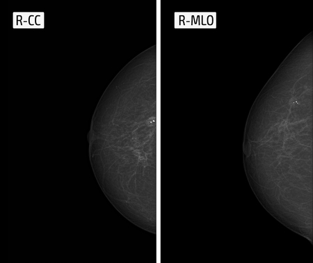 x-ray picture Mammography. Calcinates.の写真素材