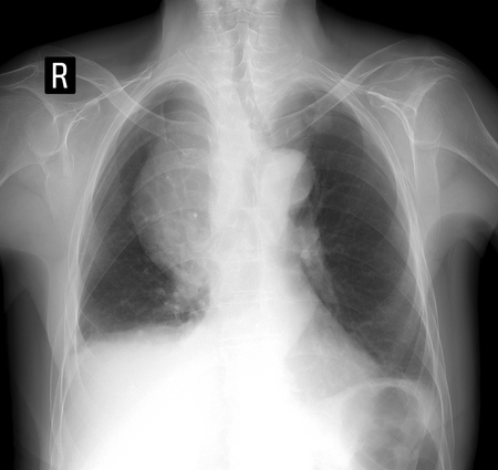 X-ray lung. Volume formation of the mediastinum.