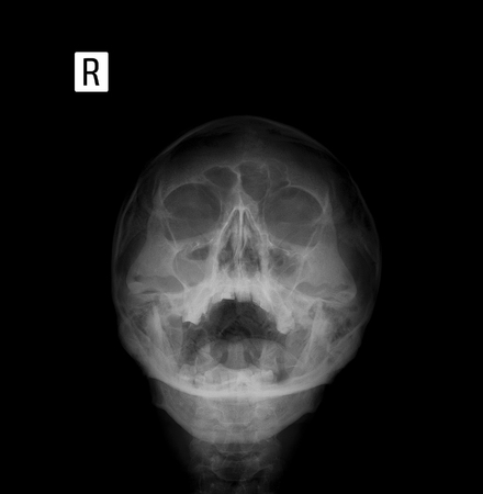 X-ray film of the face - frontal, nose-chin projection. Sinusitis.の写真素材