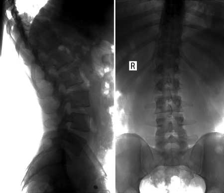 X-ray scoliosis of the lumbar spine. Negative.の写真素材