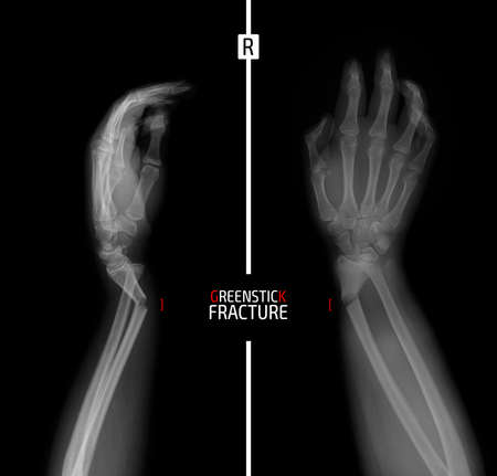 X-ray of the wrist. Greenstick fracture of the radius. Marker.の写真素材