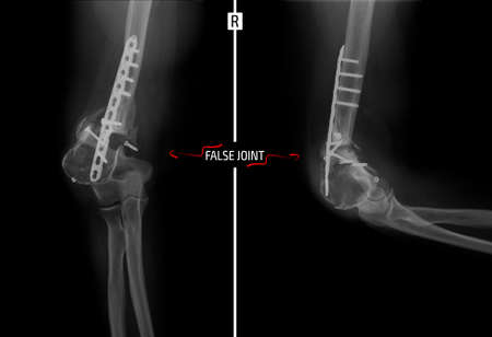 X-ray of the elbow joint. False joint. Marker.の写真素材