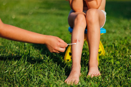A woman's hand treats a child's wound under the knee with a disinfectant. A child sits on a chair and green grass in the summer. Treatment of the wound. First aid. Cropped photoの写真素材
