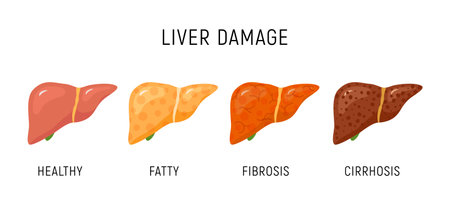 Liver damage infographic diagram cancer disease anatomy. Liver damage organ tissue hepatic carcinoma fibrosis stages.のイラスト素材