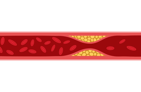 Cholesterol artery thrombosis micro vascular disease. Arteriosclerosis blood vector atherosclerosis riskのイラスト素材
