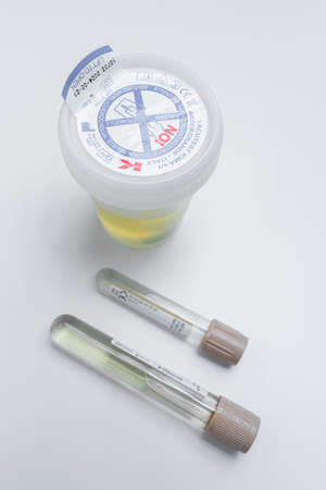 Espoo. Finland. 06 May 2021 Urine tests in medical tubes