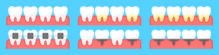 A set of teeth: healthy teeth, teeth with plaque, dental implants and braces. Dentistry. Teeth in gums. Dental treatment in a dental clinic. Flat style. Vector illustrationのイラスト素材