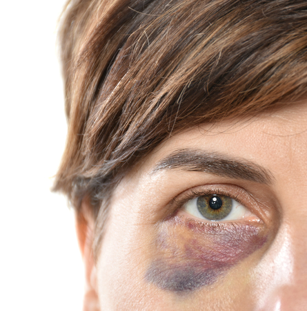 Close up of woman with bruise on her face.  Domestic violence.の写真素材