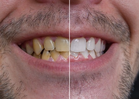Teeth whitening concept. Smiling man with yellow teeth - before and after.の写真素材