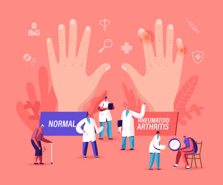 Rheumatoid Arthritis Concept. Tiny Doctor Characters Examine Huge Hand with Joints Disease and Pathology, Arms Illnessのイラスト素材