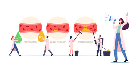 Atherosclerosis Infographics with Tiny Medic Characters Presenting Human Blood Artery Normal, Plaque Formationのイラスト素材