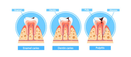 Stages Of Caries Infographics. Enamel Caries, Dentin Caries, And Pulpitis Cross Section View. Medical Visual Informationのイラスト素材