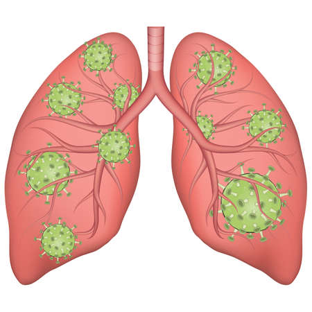 Vector medical illustration of realistic human lungs affected by coronavirus. Lung disease concept.のイラスト素材