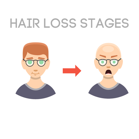 Information chart of hair loss stages types of baldness illustrated on male head vector.のイラスト素材