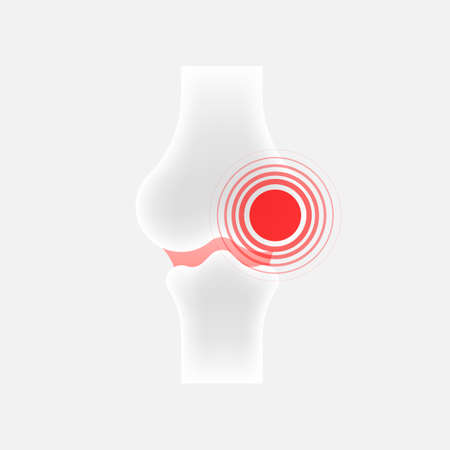Infographic with joint pain. Human knee bone joint line iconのイラスト素材