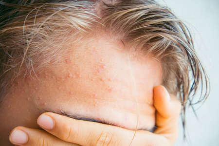 Acne on teenage boy forehead. Child is upset because of skin problemsの写真素材