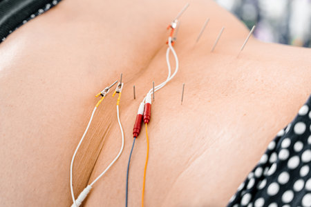 Electroacupuncture therapy with needles and wires stimulates back nerves. Pain relief. Spine...