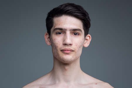 Studio portrait of a young brunette caucasian man on gray background posing. Puberty theme, problem skin, teen acne.の写真素材