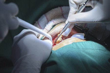 Dentist examining a patient's teeth in the dentist. The concept of dental treatment in a dental clinic.Dentist using surgical pliers to remove a decaying tooth in clinic.decayed tooth.の写真素材