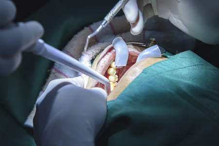 Dentist examining a patient's teeth in the dentist. The concept of dental treatment in a dental clinic.Dentist using surgical pliers to remove a decaying tooth in clinic.decayed tooth.の写真素材