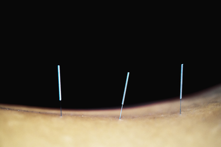 Acupuncture.Alternative medicine. Close-up of back with steel needles during procedure of acupuncture therapy.の写真素材