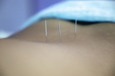 Acupuncture.Alternative medicine. Close-up of back with steel needles during procedure of acupuncture therapy.の写真素材