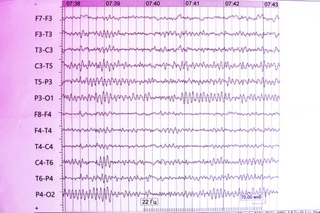 The results of the electroencephalogram on paper, diagnostics of epilepsy