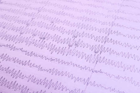 The results of the electroencephalogram on paper, diagnostics of epilepsyの写真素材