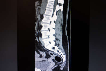 Computed tomography image of the cervical spine close upの写真素材