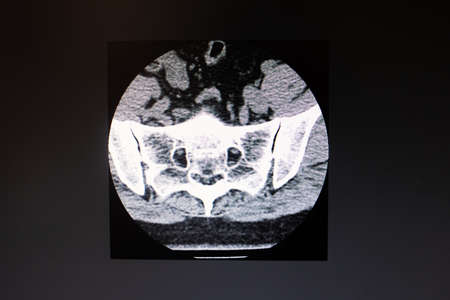 Computed tomography image of the cervical spine close upの写真素材